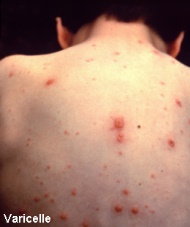A child with chickenpox