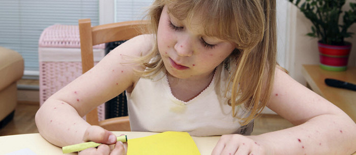 Chickenpox in children