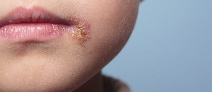 Cold sores