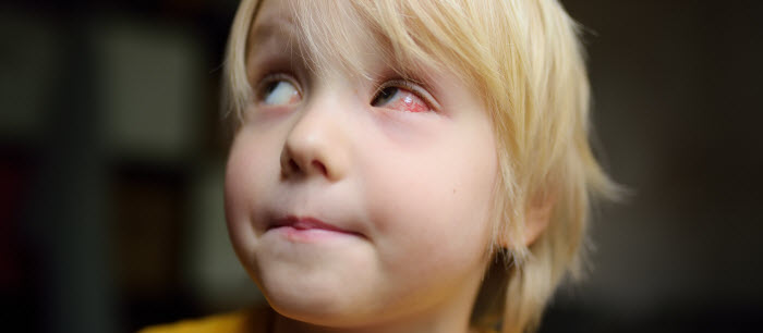 Conjunctivitis