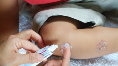 Impetigo