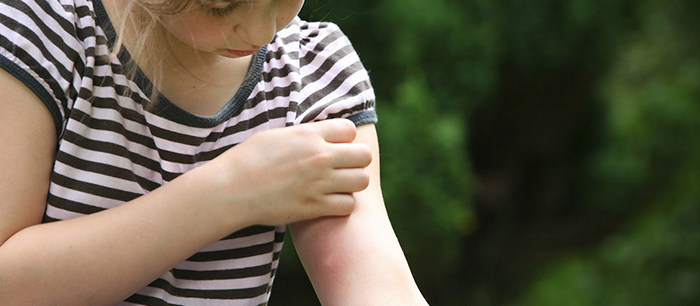 Insect bites and stings in children: Prevention and treatment