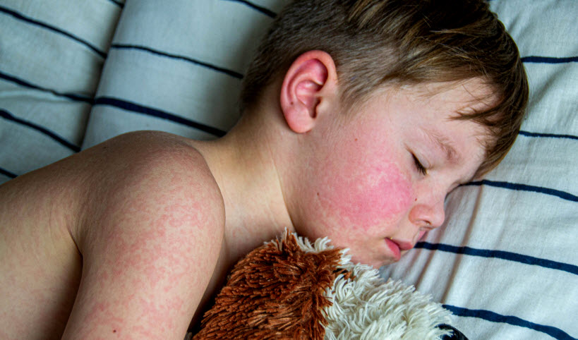 Measles
