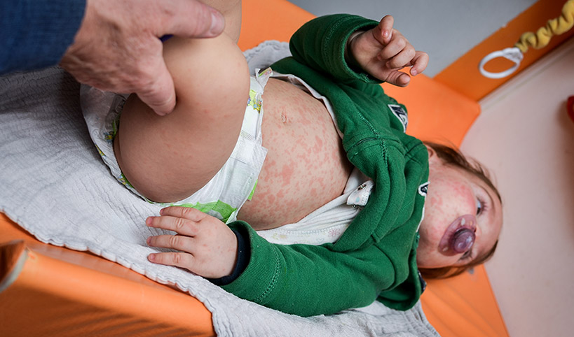 Rubella