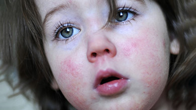 Scarlet fever